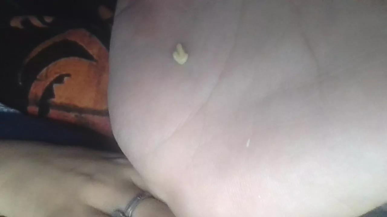 This Really Gnarly Tonsil Stone Just Popped Out Nudes Popping NUDE