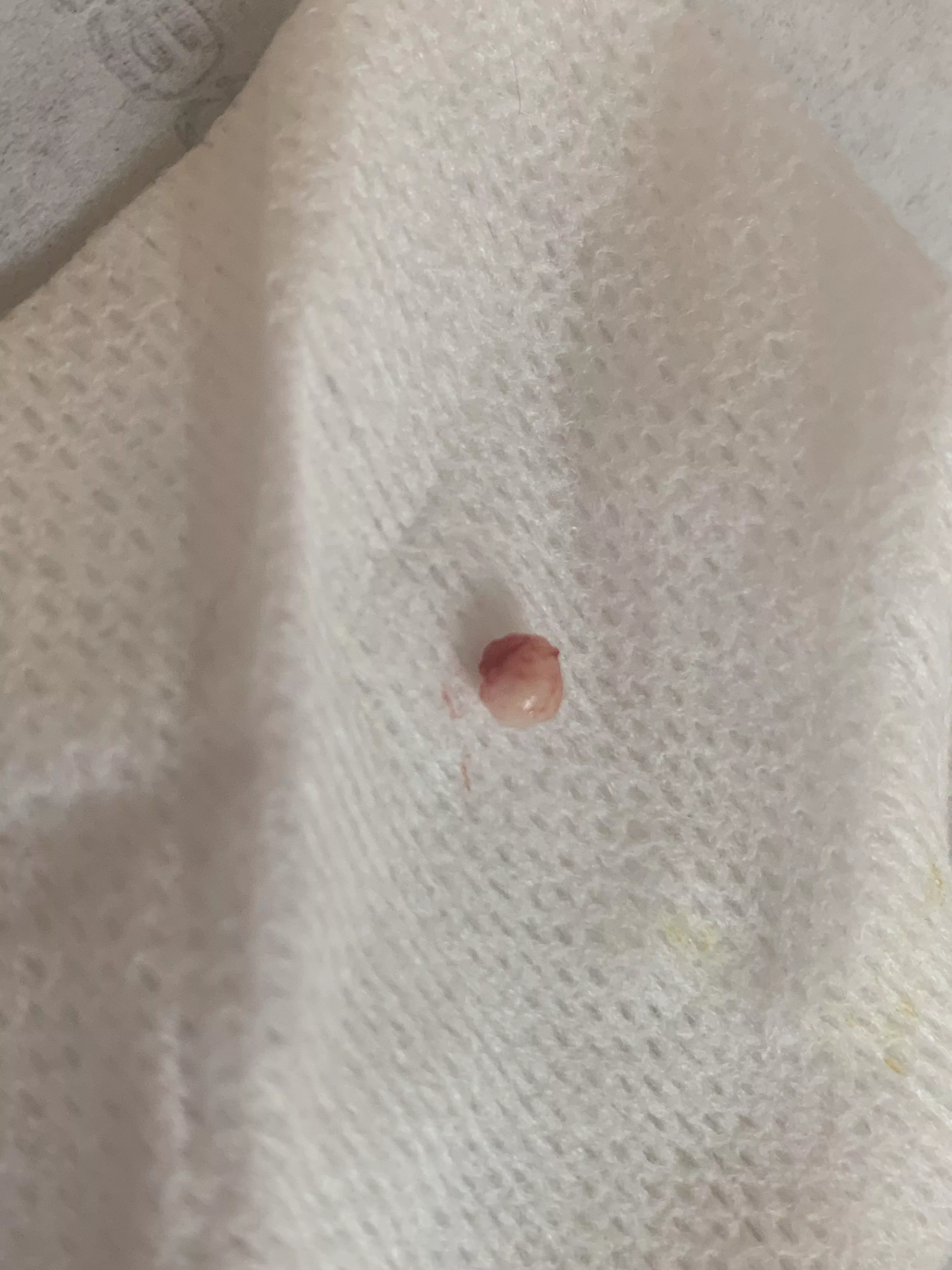 A Scalp Cyst Removed At The Dermatologist Today About The Size Of A