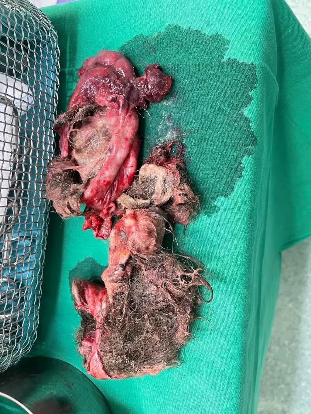 Teratoma Pic Hot Sex Picture