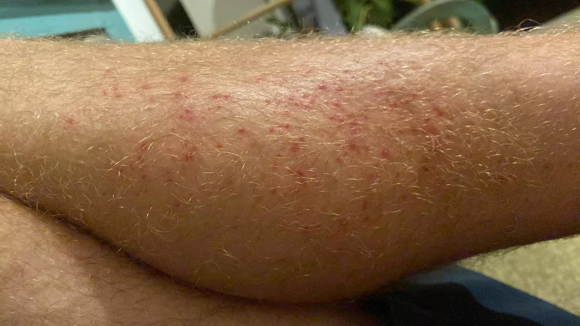 Forbidden Pops Or Not Folliculitis From A Massage Nudes Popping