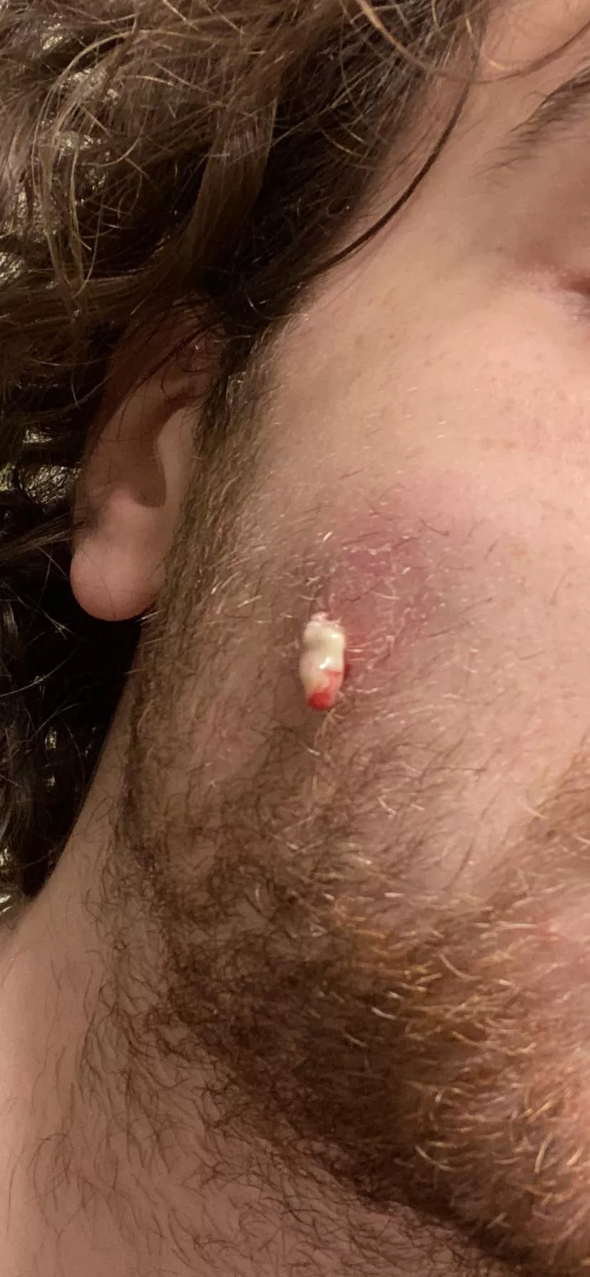 A Stubborn Pimple Caused An Infection The Size Of A Golf Ball In My Cheek Almost Spread To My