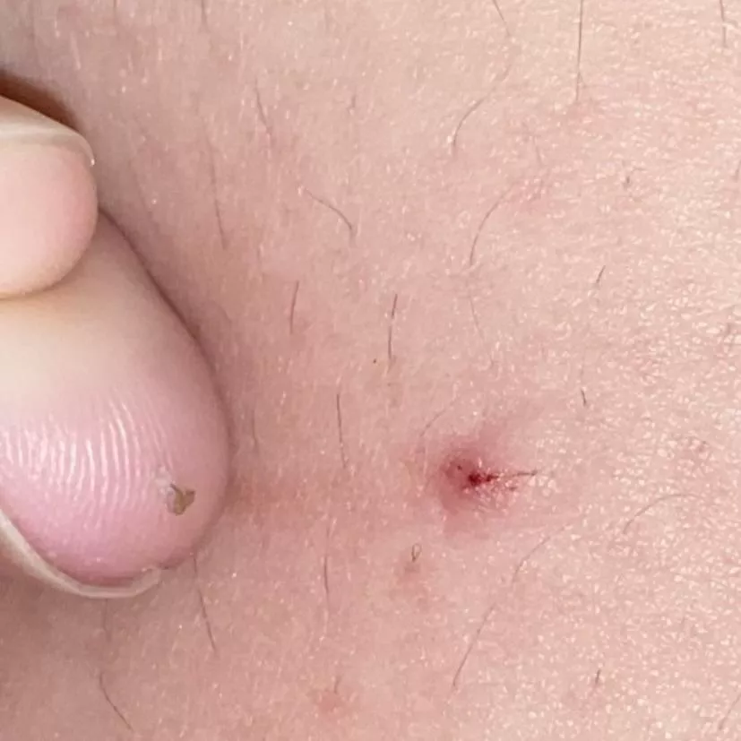 This Ingrown Hair I Popped Out Of My Thigh Nudes Popping Nude Pics Org